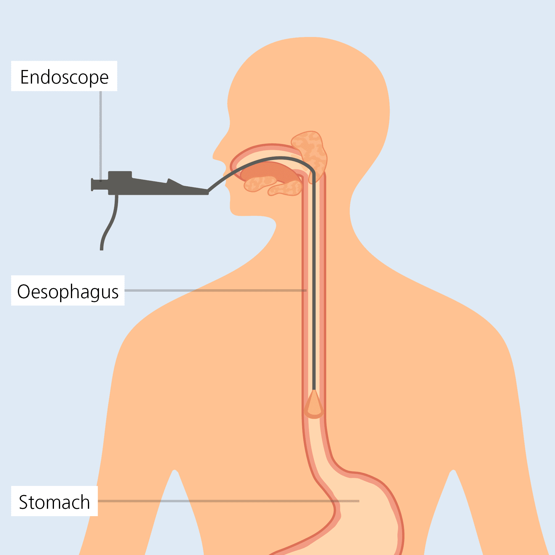 eosinophilic-esophagitis-eoe-dilation Liječenje eozinofilnog ezofagitisa dilatacijom jednjaka